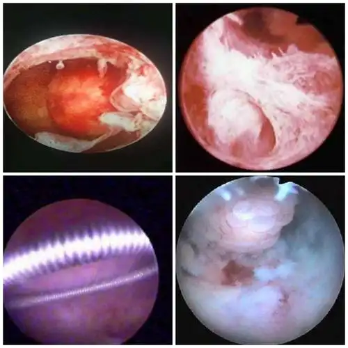 先进技术一一宫腔镜