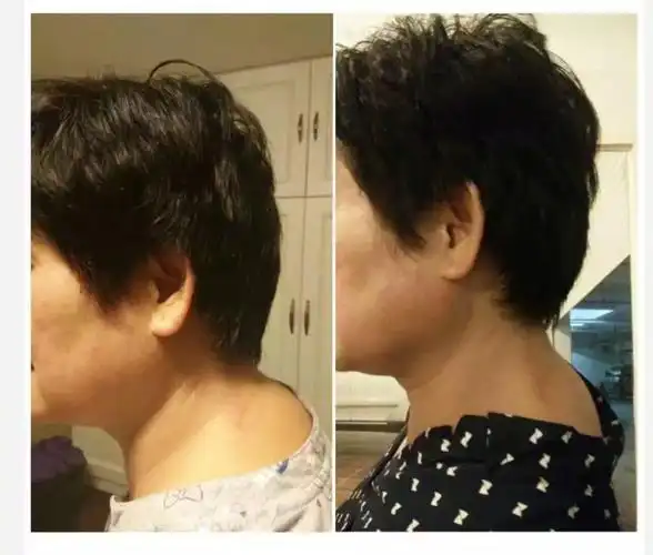 如果脑后有堆肉,同时两眼之间或有鼻横纹,或有川字纹, 你就一定要