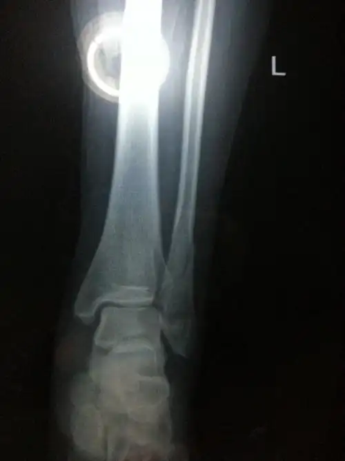 我是二月五号左脚脚踝腓骨骨裂到现在已经卧床六个星期了.