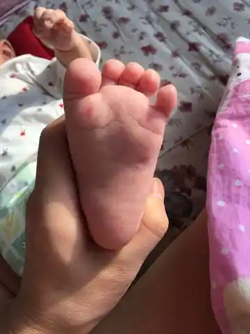 宝宝三个月了脚底这样是怎麼回事?谢谢了