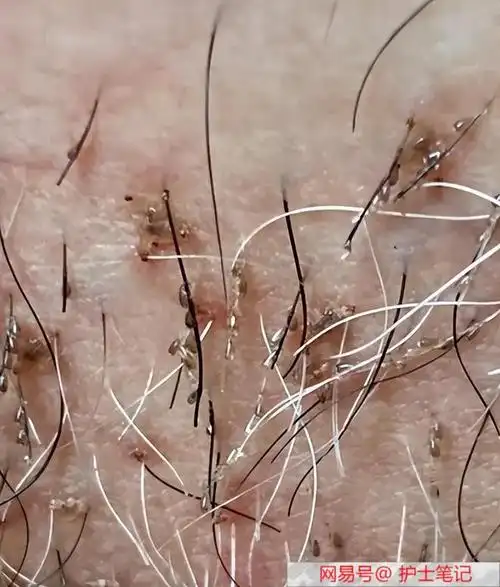 女大学生下腹瘙痒,医生夹出十几只阴虱,原来阴虱有4个传播途径|红疹