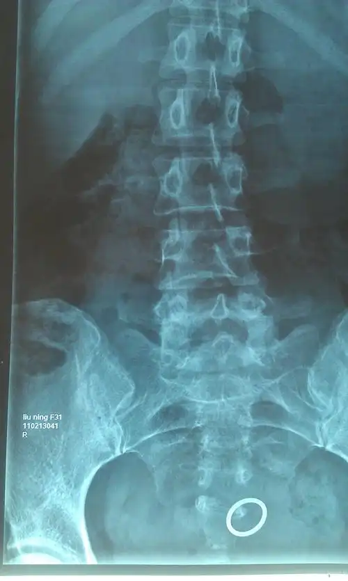 求会看x光片的大师们给看看这腰椎片有什么问题