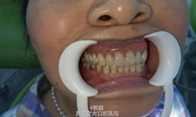 隐形排牙一例解除患者多年困扰