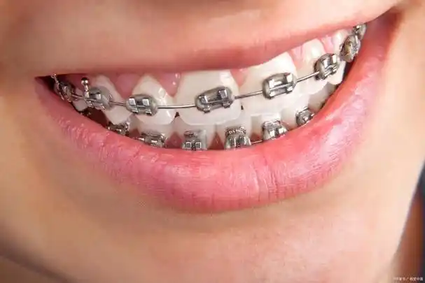 传统的钢丝牙套好吗?有哪些优点和缺点?