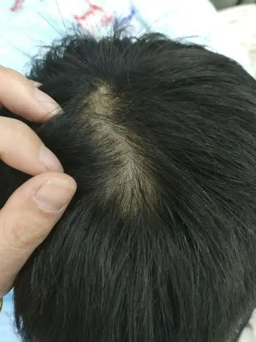 儿子今年十一岁,昨晚帮他洗完头发,发现儿子头顶有这样一块头发稀少