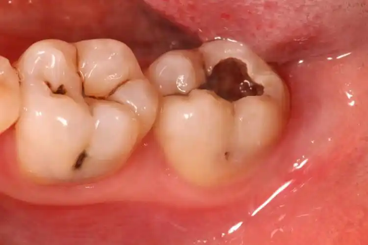 别让牙齿烂这么严重