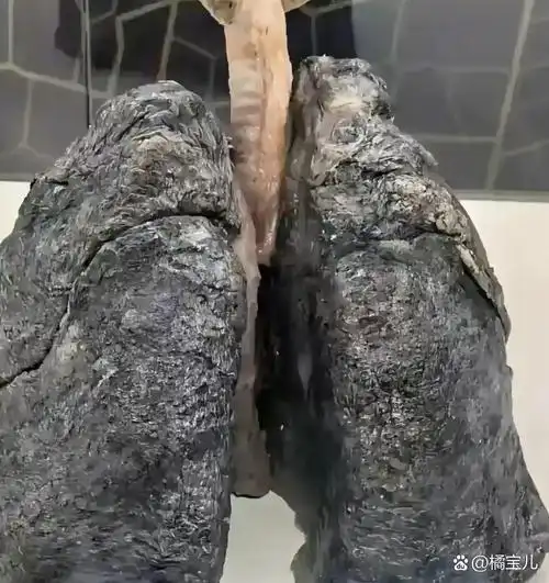 这是一个烟龄超过10年老烟民的肺,整个都是黑色的,而且看起来有点像是