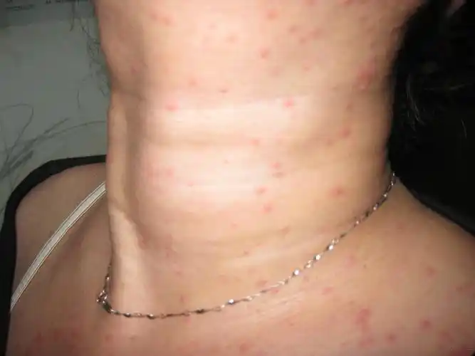 风疹么?(附图片)