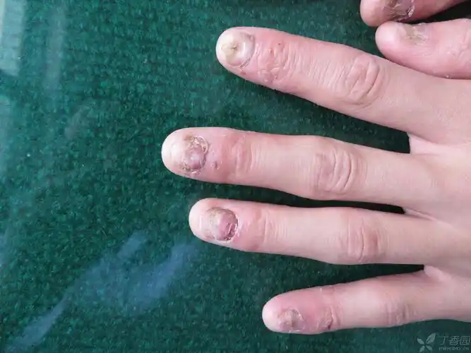 【请教】看看这指甲,营养不良甲?肢端皮炎?扁平苔藓?甲癣?
