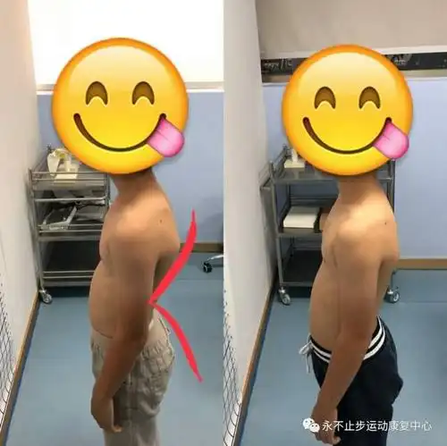 孩子含胸驼背怎么破 | 青少年不良体态及康复线下沙龙回顾