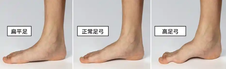 着没足弓,站起来也没足弓的,就像下图这样,那么我们叫它结构型扁平足