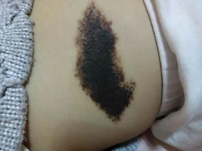刚出生就有的黑色胎记,长肚子上的,现在女儿三岁了,胎记还是那么大,我