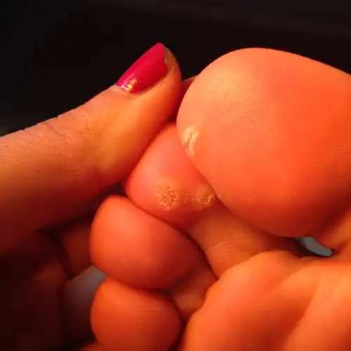 是鸡眼么,有些痛.越长越多.起初才两个 现在四个了.