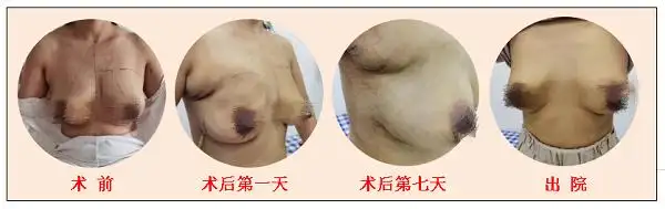 我院乳腺科成功开展首例乳房重建术