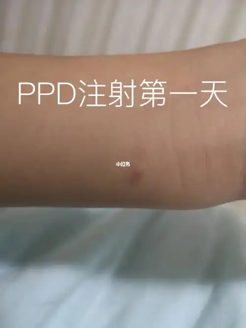 ppd皮试注射第一天