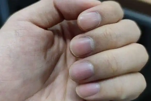 指甲生长是由甲根部的甲基质细胞不断增生,角化,移行而成.