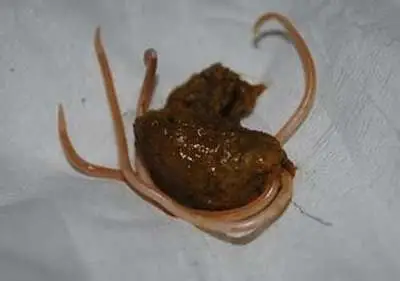 怎么知道肚子里现在还有蛔虫吗