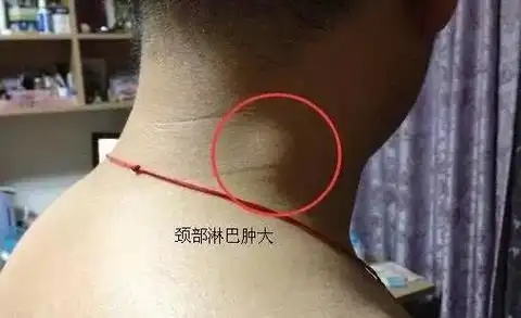 遇到炎症性淋巴结肿大,靠按摩把它消失,诚实的告诉你,按摩非但不会