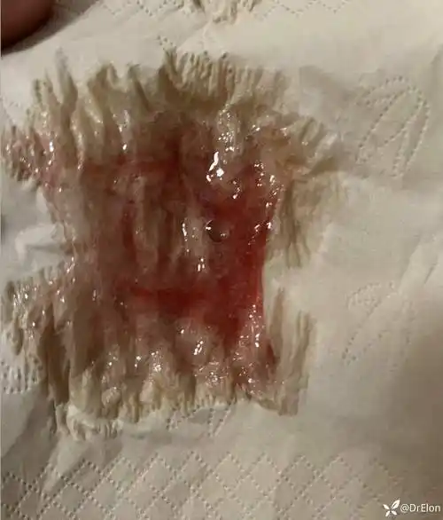 潜血,当时主要注意力在治疗大便潜血,而忽视了没有及时服药治疗痰血