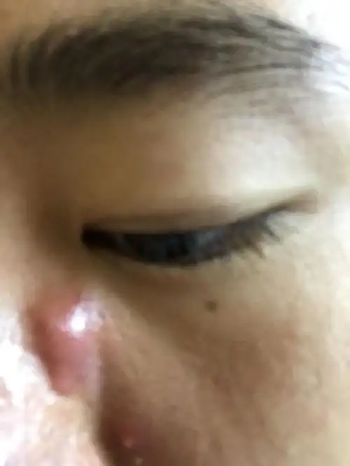 鼻子两侧起了个这个大包,咋回事啊