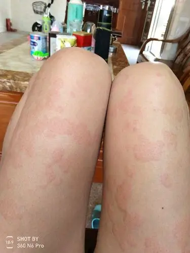 大家进来帮我看看这是荨麻疹吗?