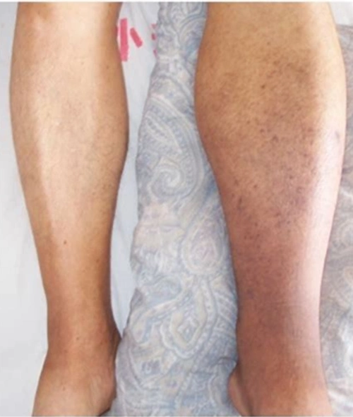 疫情期间宅在家,小心下肢静脉血栓_下肢静脉血栓_症状表现_如何预防