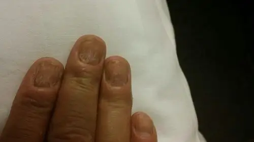 我用治灰指甲的方法治疗了一个月但没有明显好转,手指渗水后指甲