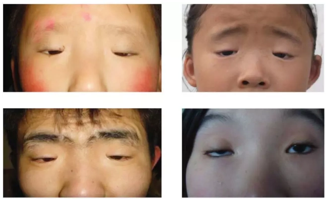 眼睛长得太小,竟然是种病?