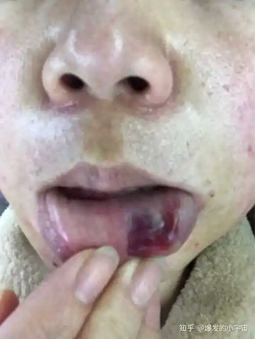 玻尿酸鼻头栓塞的症状图片,玻尿酸隆鼻一周后栓塞