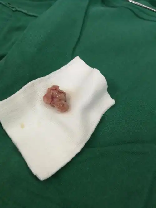 耳鼻咽喉科引进低温等离子手术系统,成功开展了患者双侧扁桃体切除术