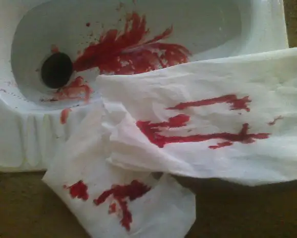 《季铭冬告别痔疮经历》提到的办-法这个就挺不错的,之前大便出血总算