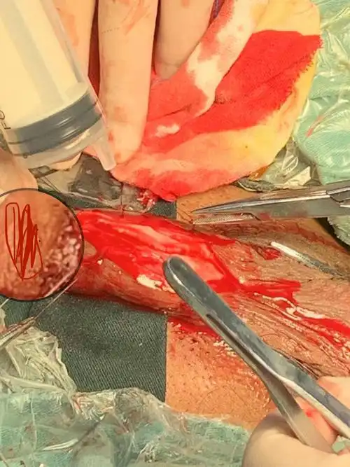 两例手术完美结束,回顾整个手术过程,行云流水般流畅,从尿道切开,到取