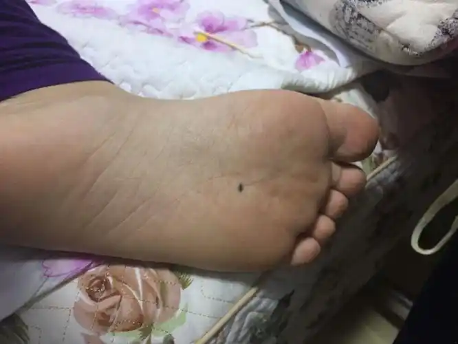  追问 左脚脚底