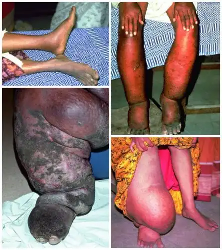 丝虫病中的皮肤表现