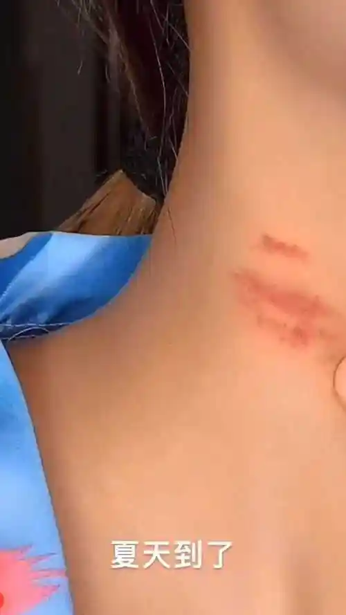 夏天到了脖子上有草莓印会显尴尬几分钟教你去除
