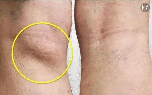 膝盖后面查出腘窝囊肿?不要太担心,骨科医生教给你该怎么办.