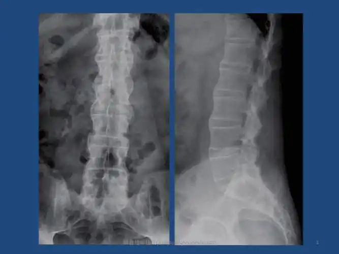 强直性脊柱炎ankylosingspondylitisas课件