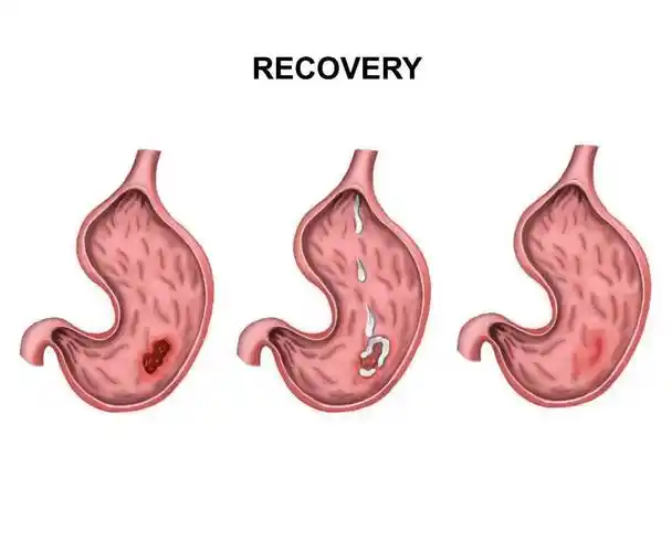 通过胃镜检查,医生发现邹女士的胃角小弯侧有一个电池扣大小的溃疡面