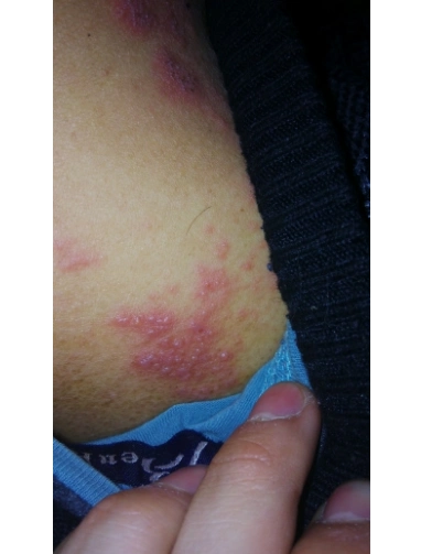 艾滋病早期发病图片 (3)