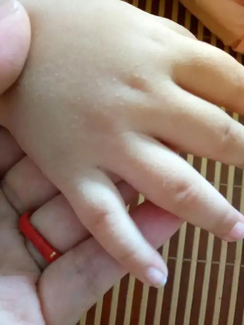 宝宝手上有小疙瘩