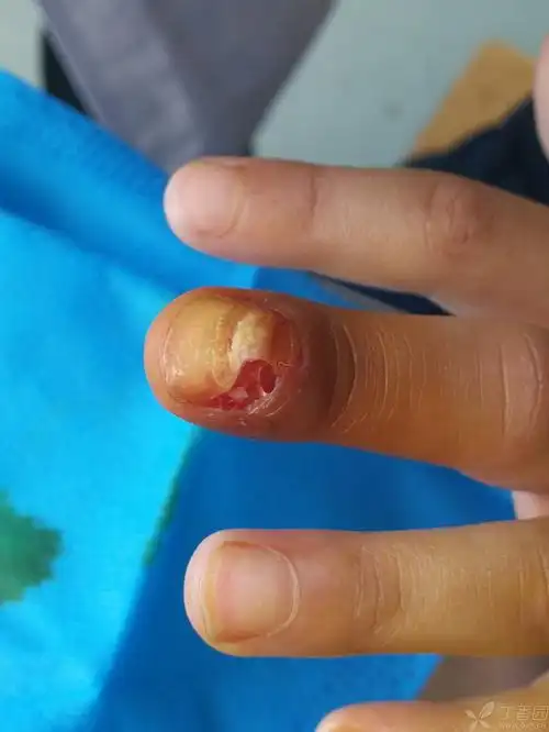指甲畸形生长3周