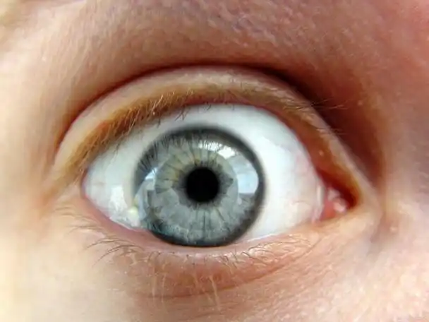 高度近视造成眼球突出能恢复吗?