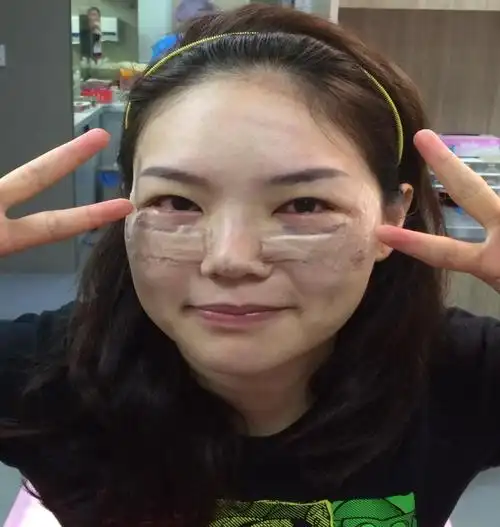 眼袋失败修复效果图 你觉得怎么样