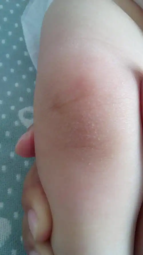 宝宝2个半月了.可身上.胳膊.腿上都出来像爆皮一样.是怎么回事阿.