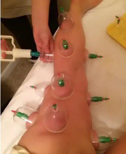 腿下肢静脉曲张手术分解图片_有来医生