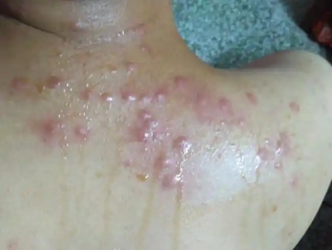 床虱咬到人的皮肤图片,床虱一般藏在哪里?