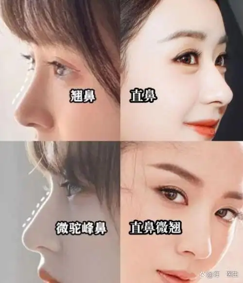 直鼻和翘鼻到底应该怎么选?