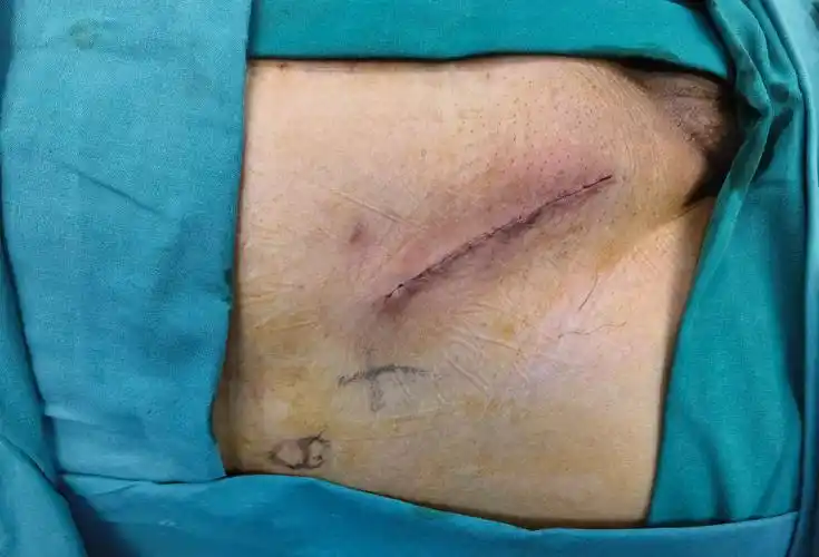 三个洞洞微创治疗彻底解决"疝气" - 好大夫在线