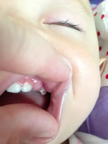 宝宝牙龈上长了个白色长条形状的脓包