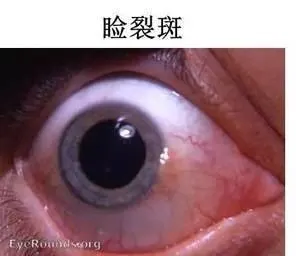 因睑裂斑内无血管,故更明显,其病理改变为结膜实质的玻璃样变性和弹力